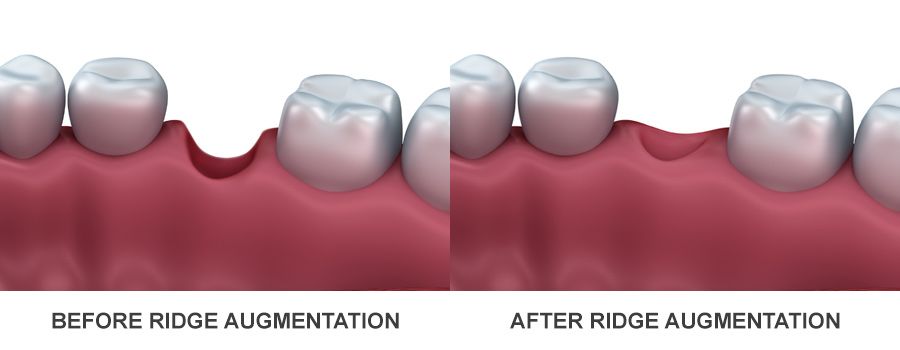 ridge augmentation