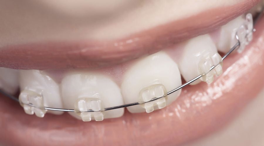 clear braces