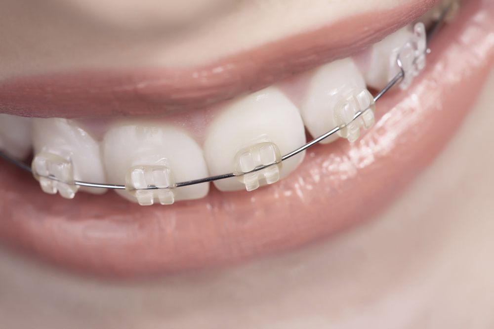 ceramic braces