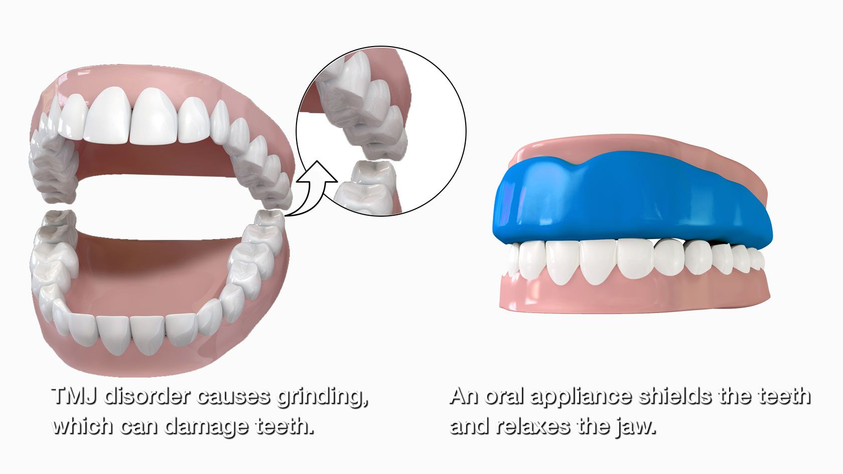 Before and after oral appliance therapy