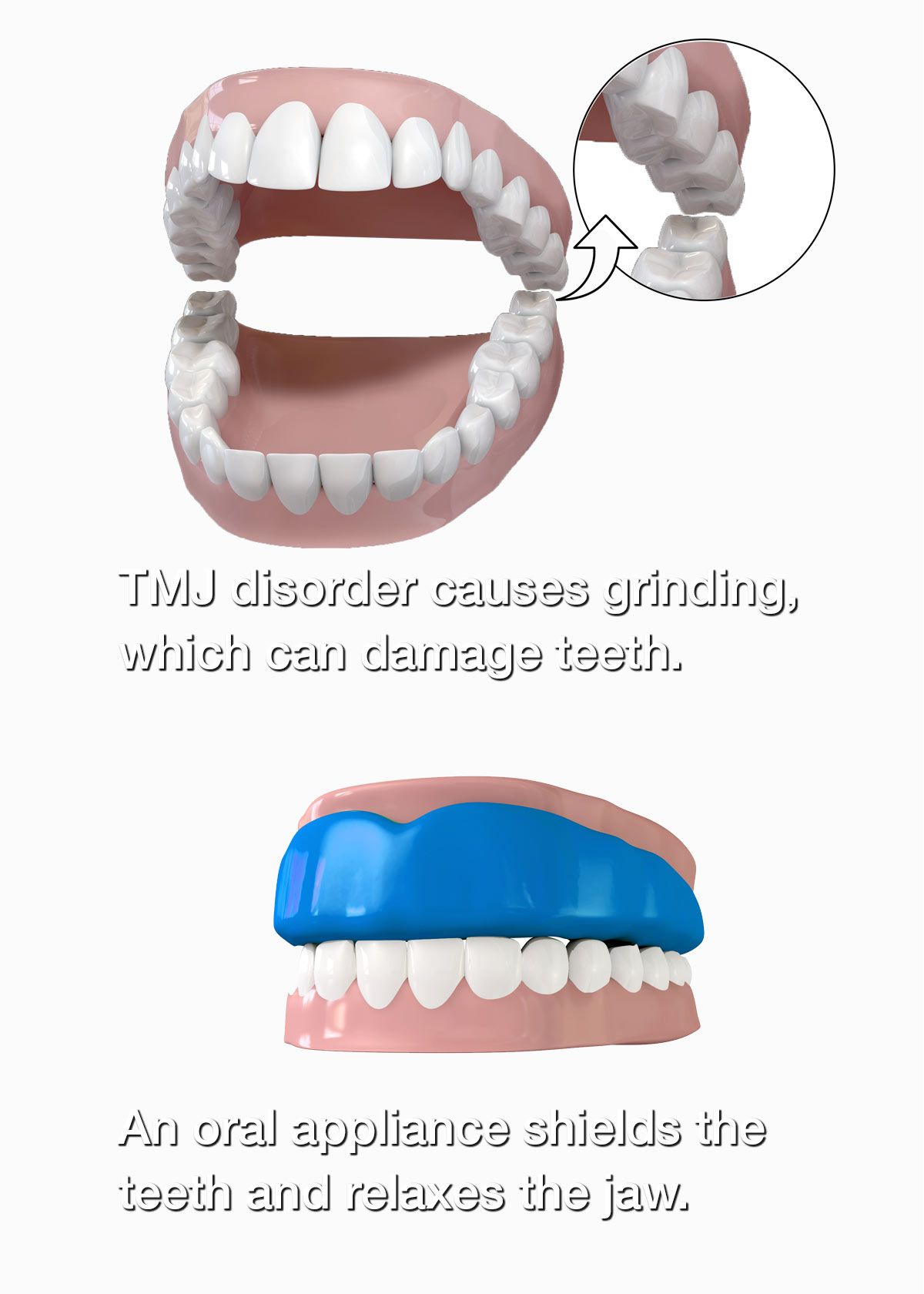 Before and after oral appliance therapy