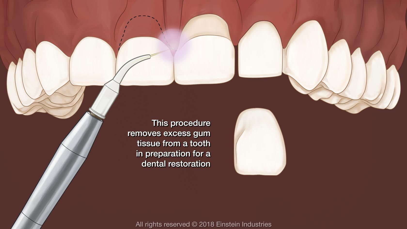 crown lengthening