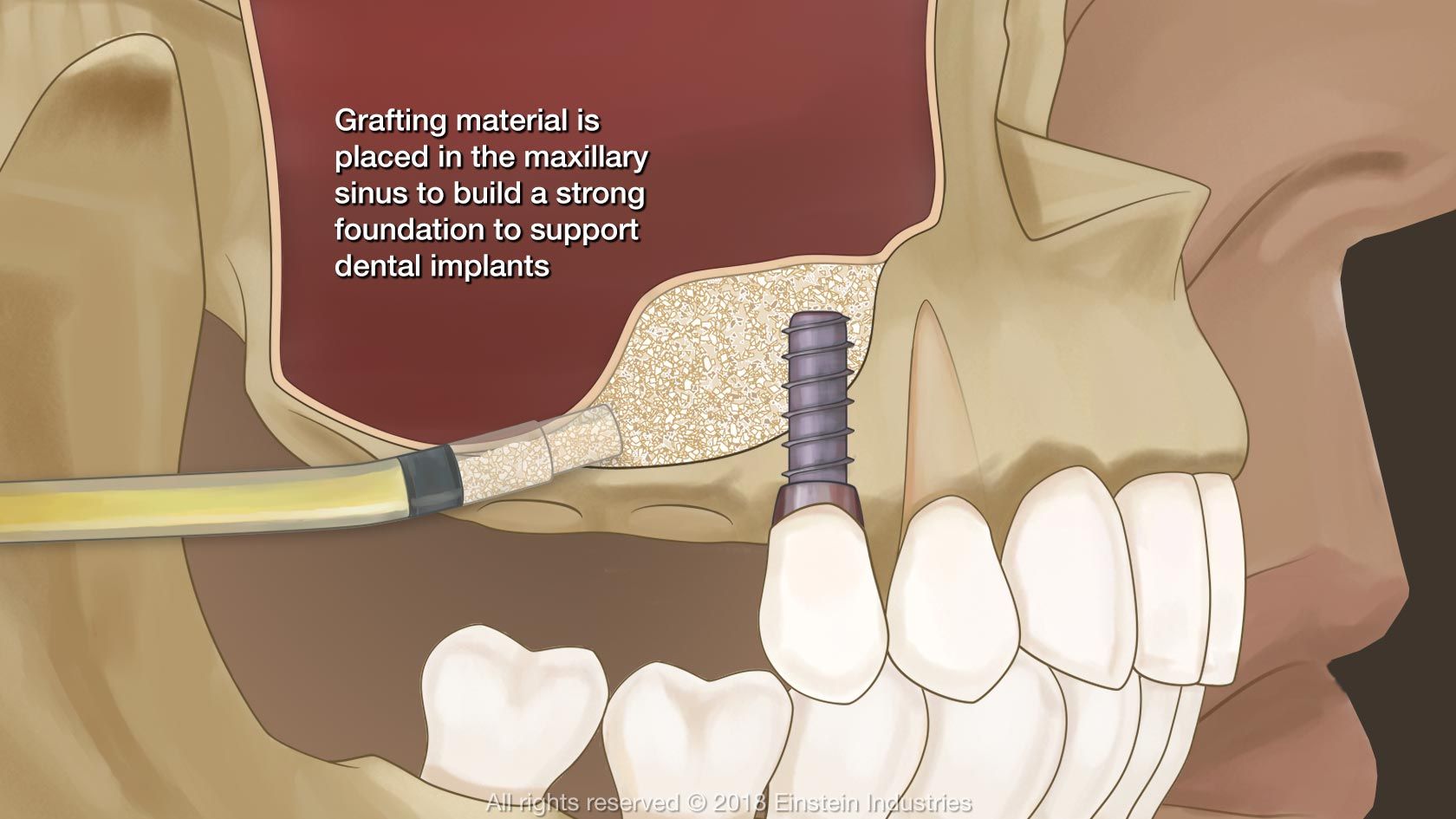 Sinus lift illustration