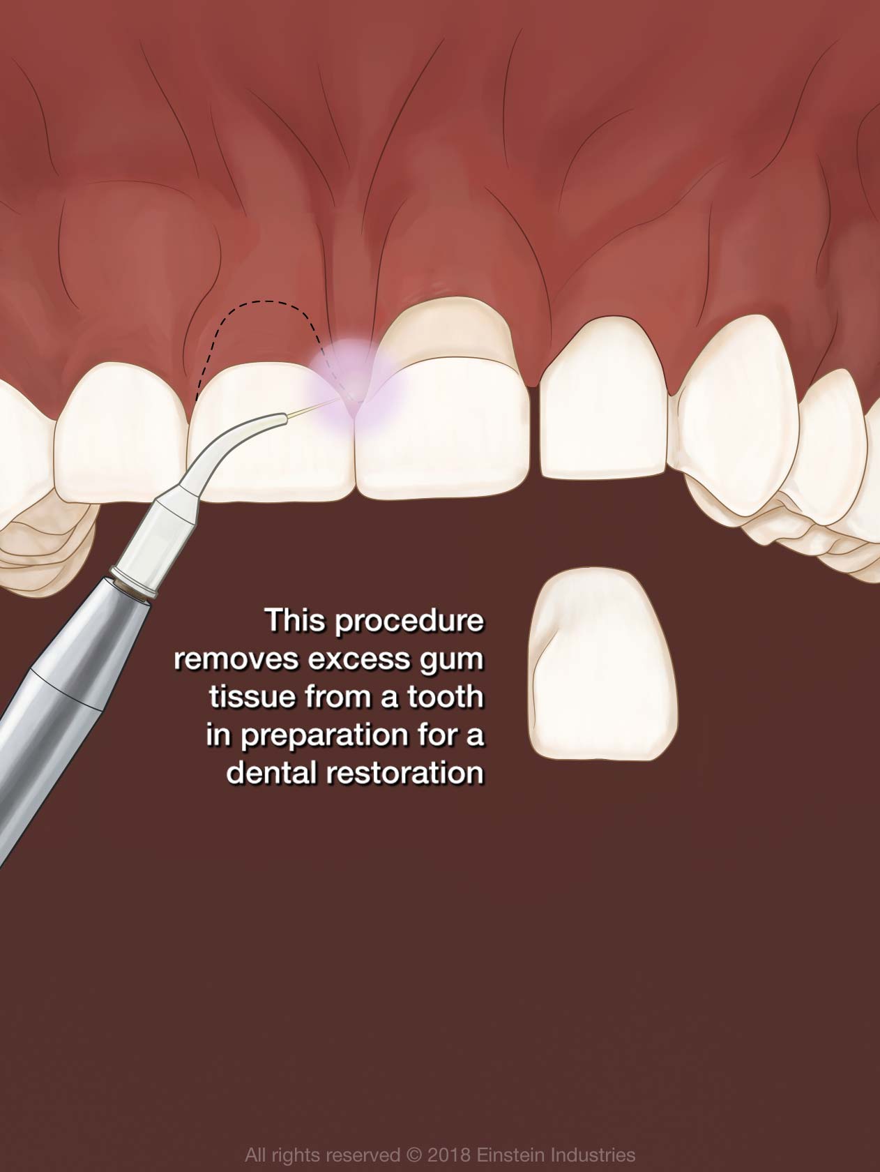 crown lengthening