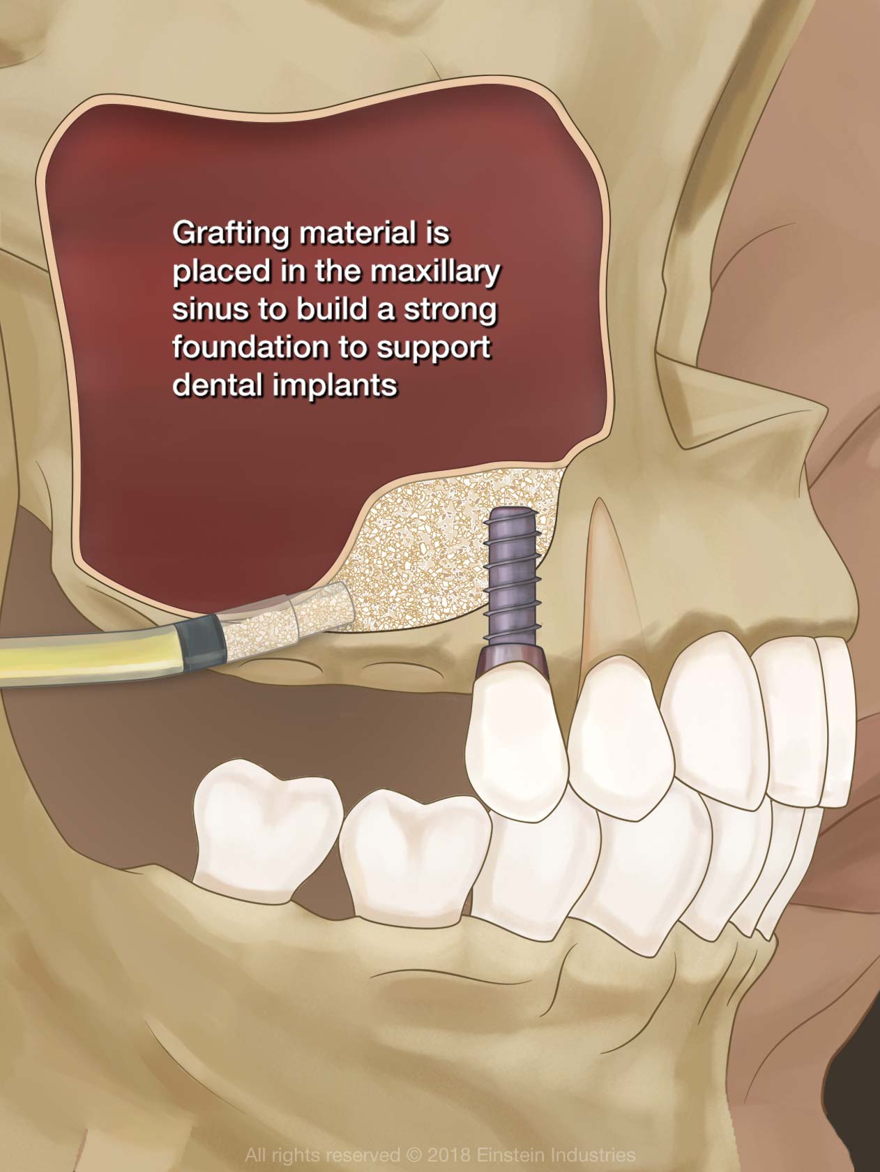 Sinus lift illustration