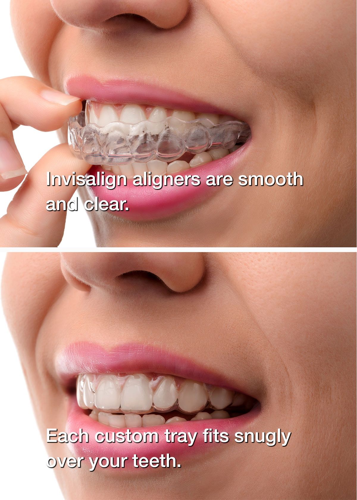 Invisalign on teeth
