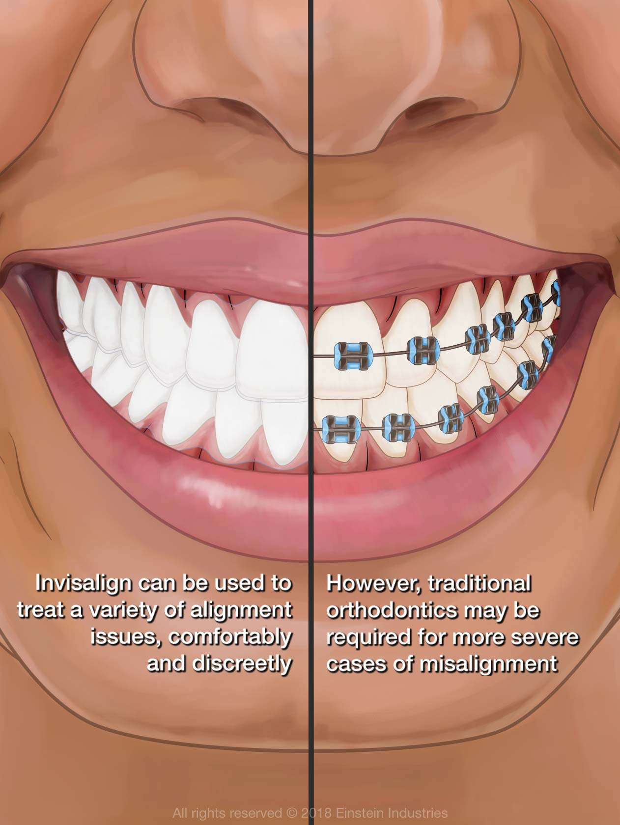 Invisalign vs. Braces