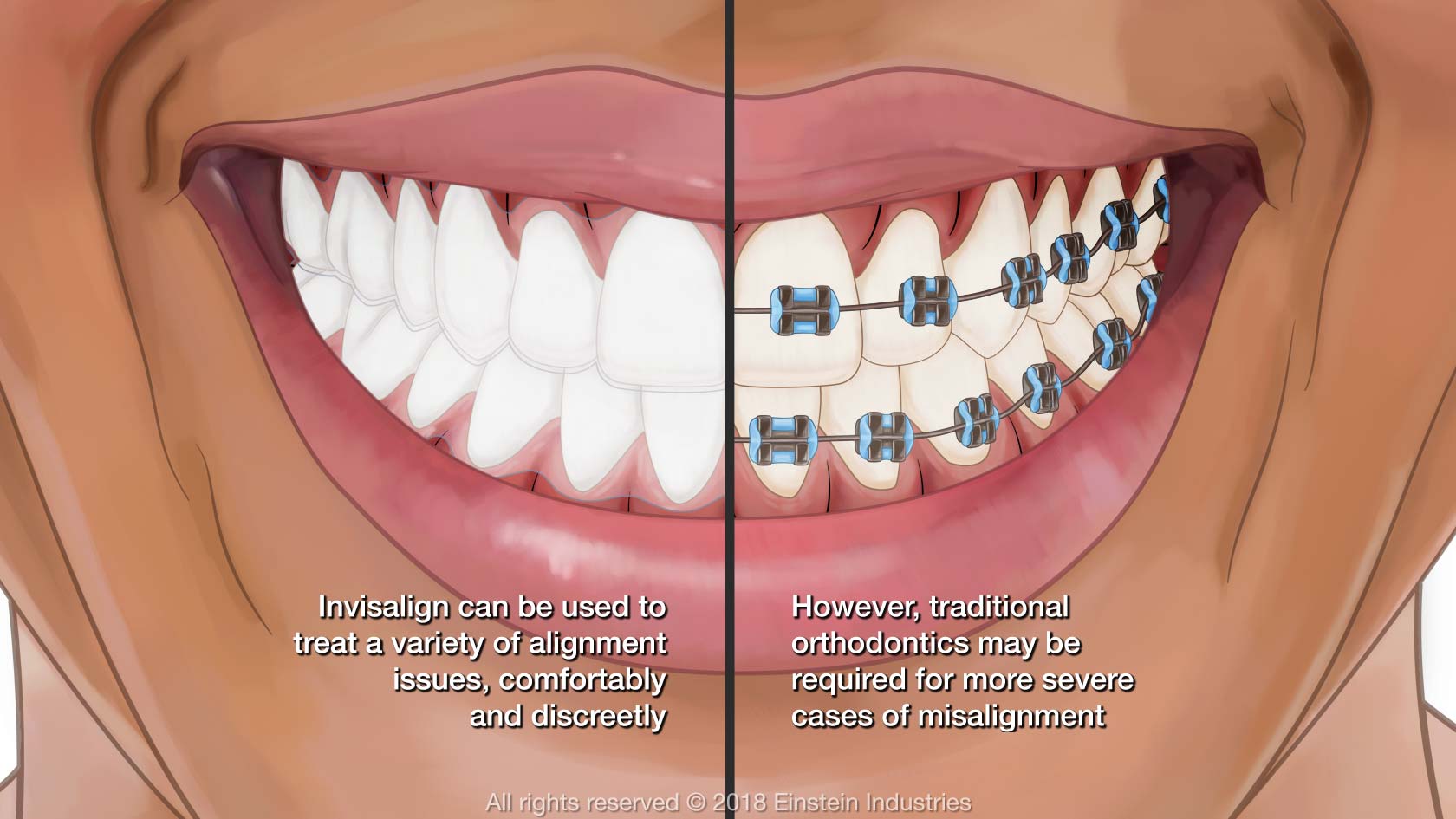 Invisalign vs. Braces