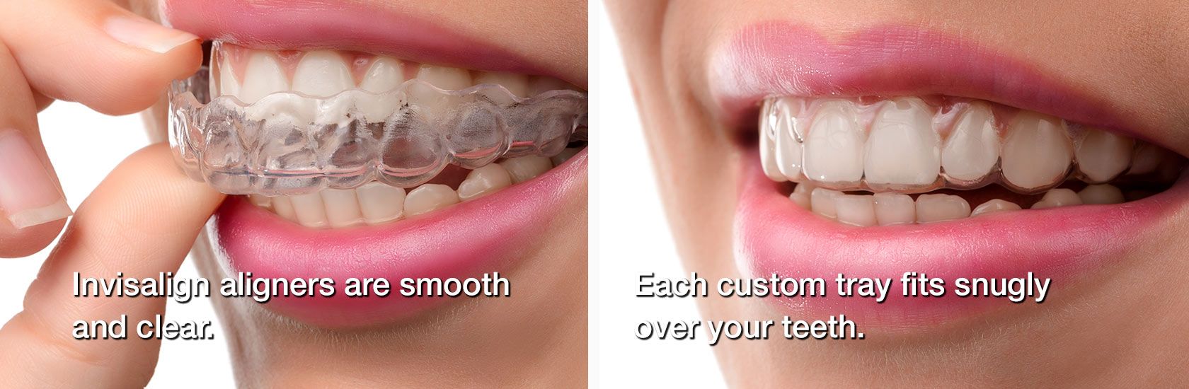 Invisalign on teeth