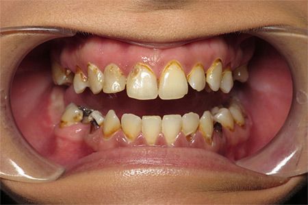 before/after dental treatment